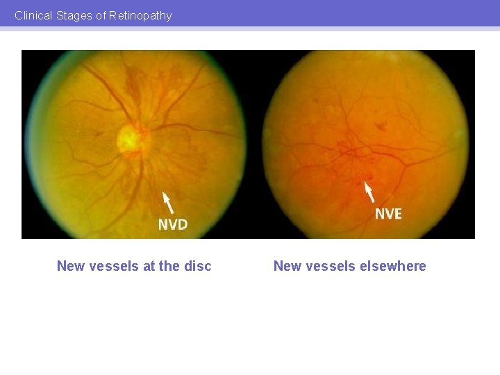 Clinical Stages of Retinopathy New vessels at the disc New vessels elsewhere 