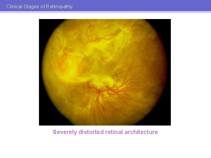 Clinical Stages of Retinopathy Severely distorted retinal architecture 