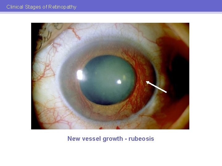 Clinical Stages of Retinopathy New vessel growth - rubeosis 