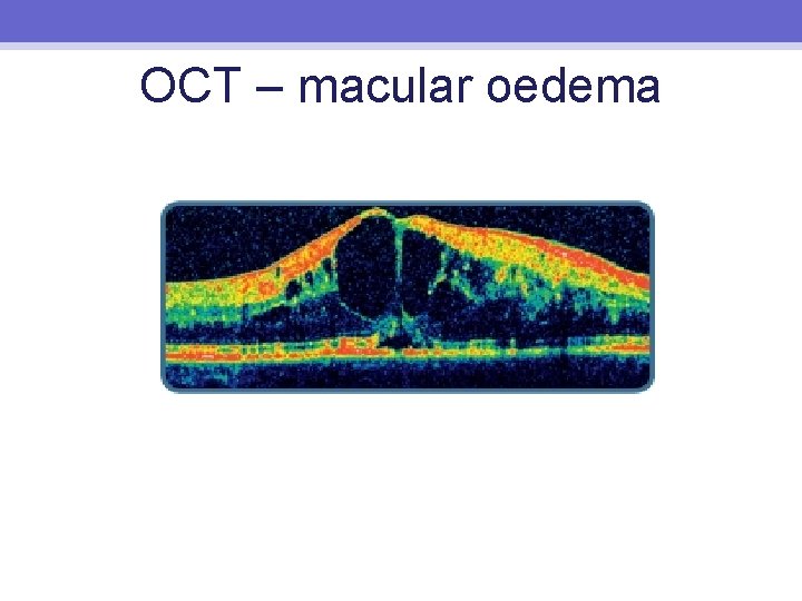 OCT – macular oedema 