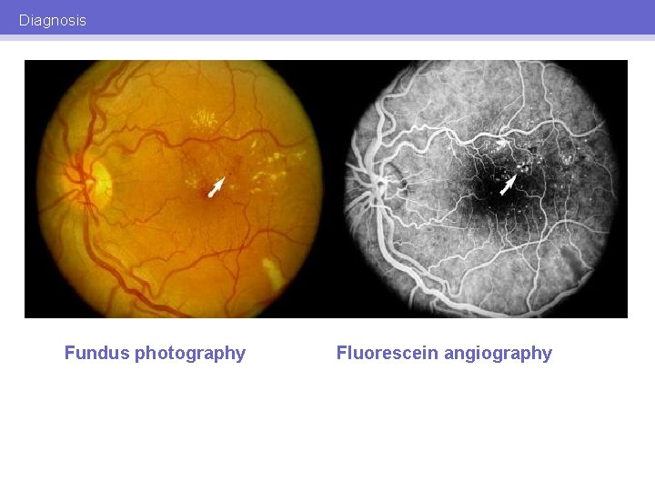 Diagnosis Fundus photography Fluorescein angiography 
