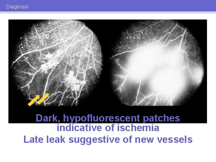 Diagnosis Dark, hypofluorescent patches indicative of ischemia Late leak suggestive of new vessels 