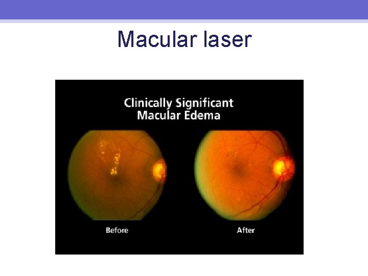 Macular laser 