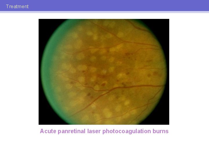 Treatment Acute panretinal laser photocoagulation burns 