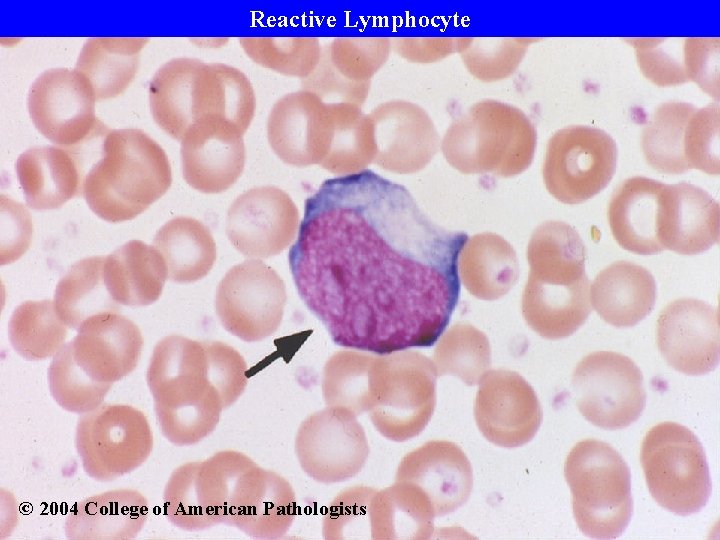 Reactive Lymphocyte © 2004 College of American Pathologists 
