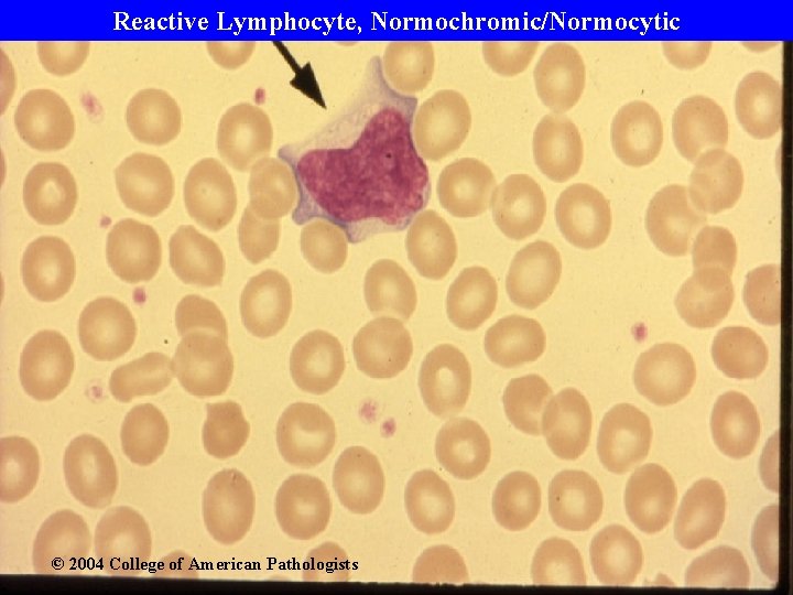 Reactive Lymphocyte, Normochromic/Normocytic © 2004 College of American Pathologists 