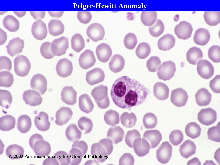 Pelger-Hewitt Anomaly © 2003 American Society for Clinical Pathology 