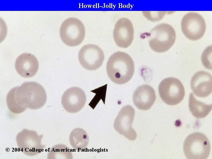 Howell-Jolly Body © 2004 College of American Pathologists 