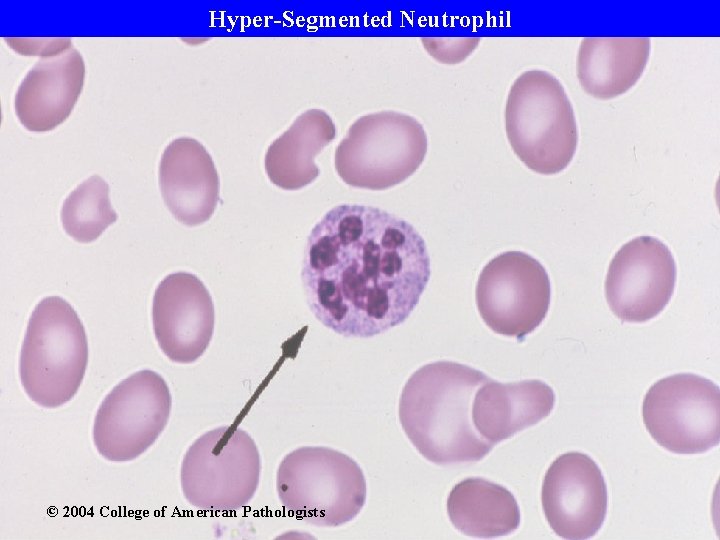 Hyper-Segmented Neutrophil © 2004 College of American Pathologists 