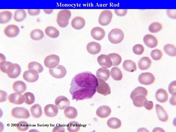 Monocyte with Auer Rod © 2003 American Society for Clinical Pathology 