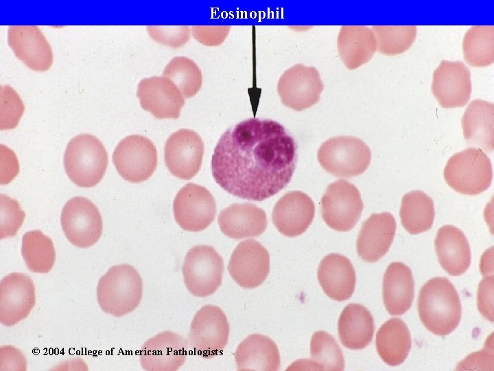 Eosinophil © 2004 College of American Pathologists 