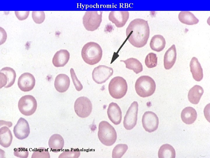 Hypochromic RBC © 2004 College of American Pathologists 