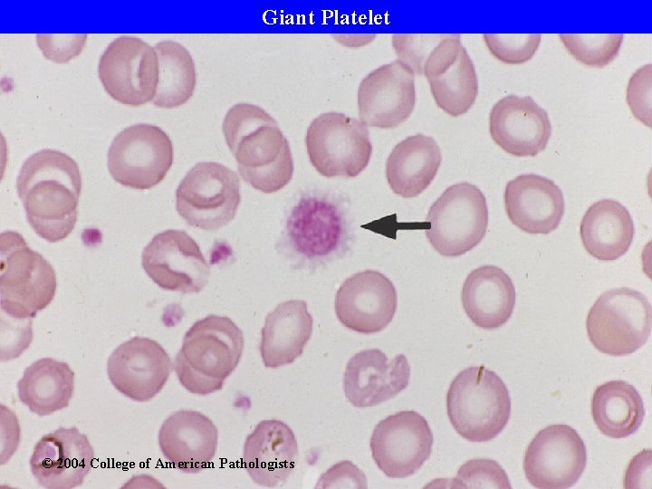 Giant Platelet © 2004 College of American Pathologists 