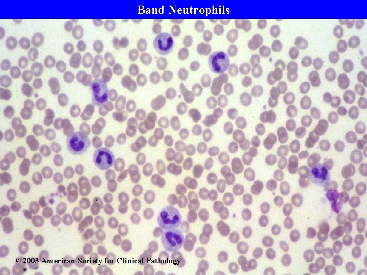 Band Neutrophils © 2003 American Society for Clinical Pathology 