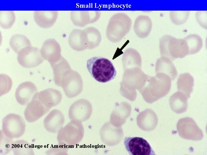 Small Lymphocyte © 2004 College of American Pathologists 