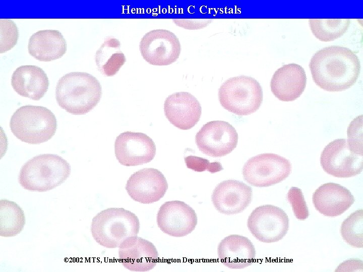 Hemoglobin C Crystals © 2002 MTS, University of Washington Department of Laboratory Medicine 