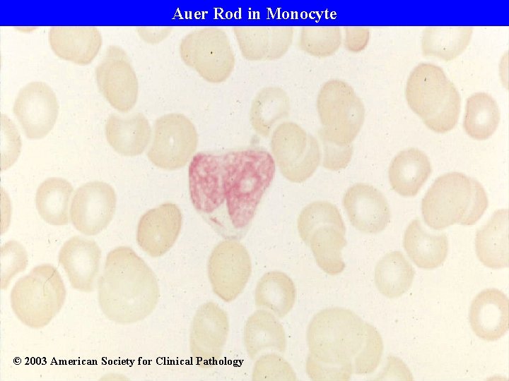 Auer Rod in Monocyte © 2003 American Society for Clinical Pathology 