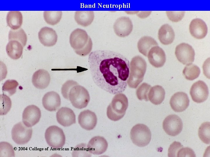 Band Neutrophil © 2004 College of American Pathologists 
