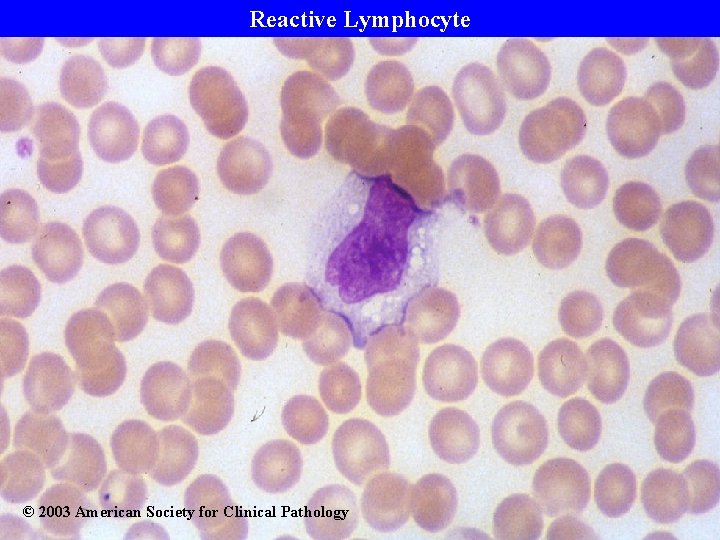 Reactive Lymphocyte © 2003 American Society for Clinical Pathology 