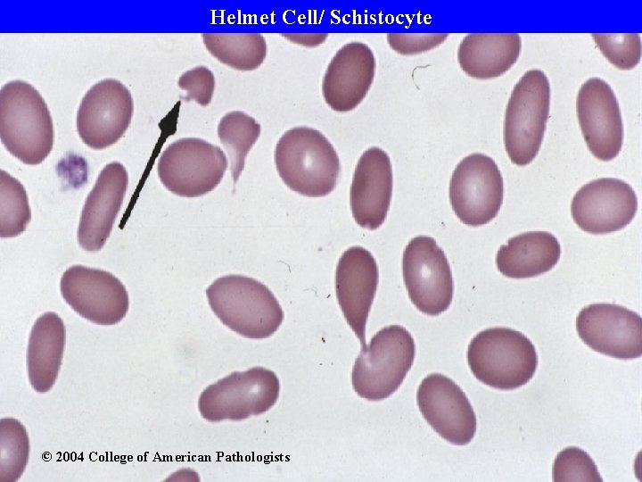 Helmet Cell/ Schistocyte © 2004 College of American Pathologists 