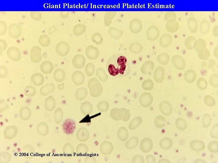 Giant Platelet/ Increased Platelet Estimate © 2004 College of American Pathologists 