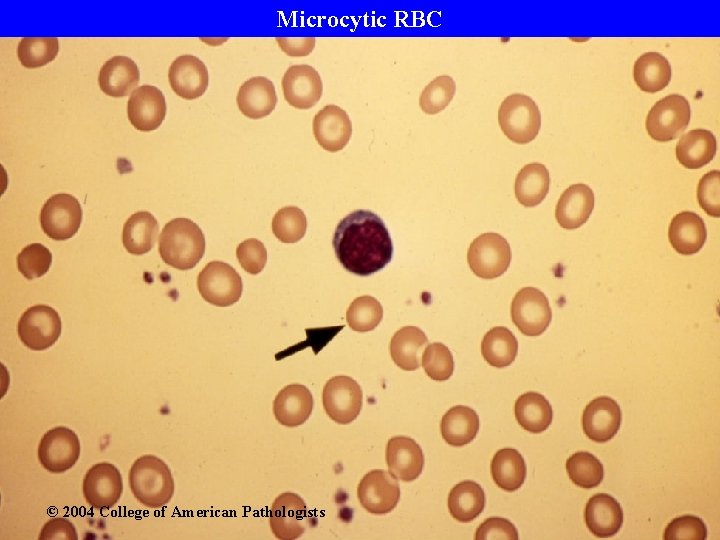 Microcytic RBC © 2004 College of American Pathologists 