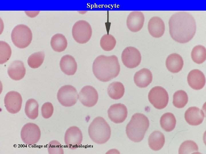 Spherocyte © 2004 College of American Pathologists 