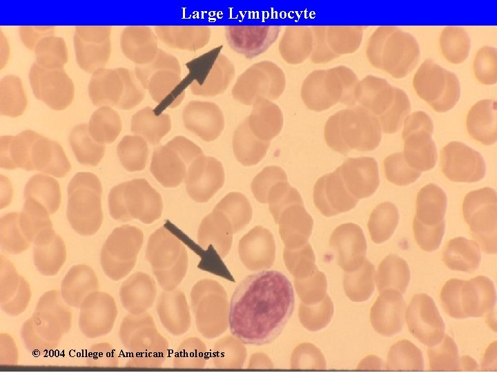 Large Lymphocyte © 2004 College of American Pathologists 