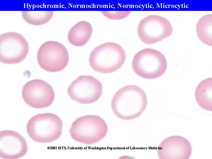 Hypochromic, Normocytic, Microcytic © 2002 MTS, University of Washington Department of Laboratory Medicine 