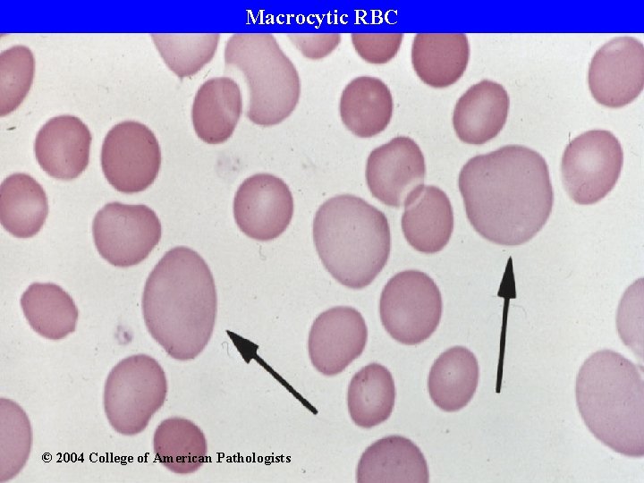 Macrocytic RBC © 2004 College of American Pathologists 