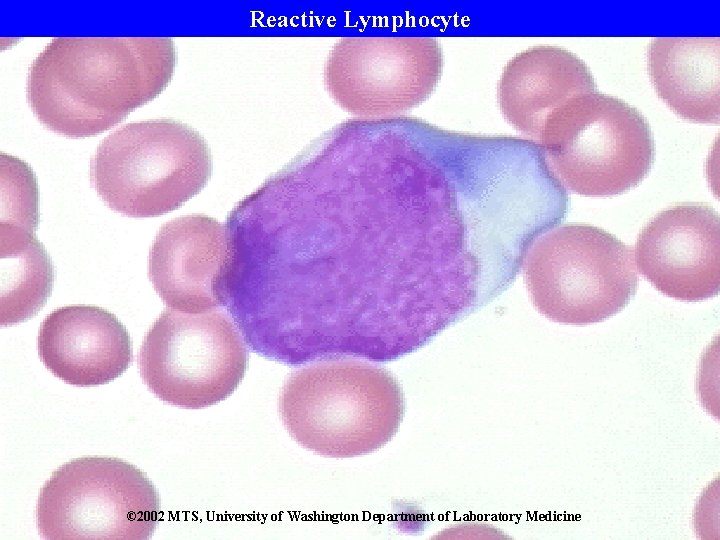 Reactive Lymphocyte © 2002 MTS, University of Washington Department of Laboratory Medicine 