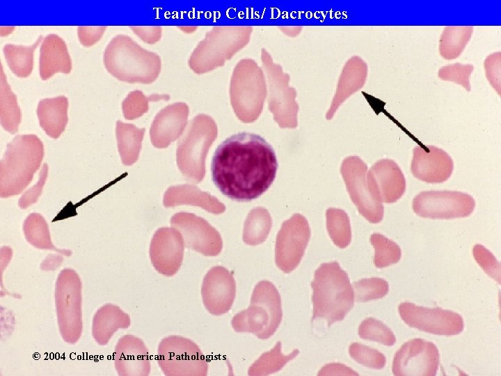 Teardrop Cells/ Dacrocytes © 2004 College of American Pathologists 