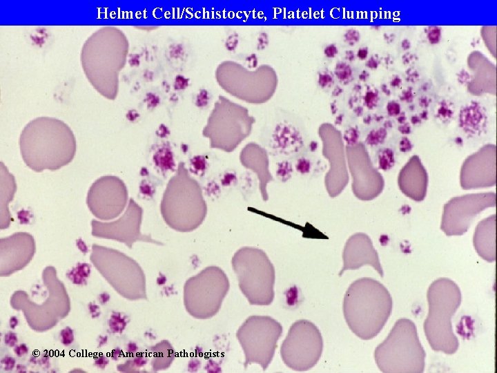 Helmet Cell/Schistocyte, Platelet Clumping © 2004 College of American Pathologists 
