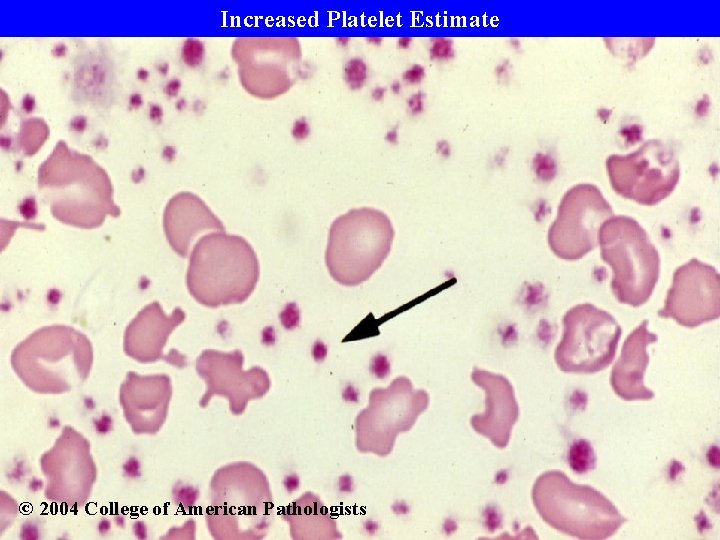 Increased Platelet Estimate © 2004 College of American Pathologists 