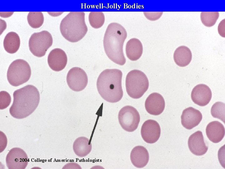 Howell-Jolly Bodies © 2004 College of American Pathologists 