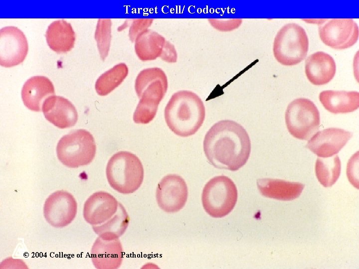 Target Cell/ Codocyte © 2004 College of American Pathologists 