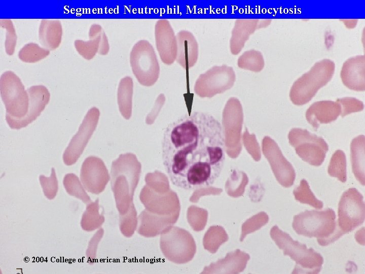 Segmented Neutrophil, Marked Poikilocytosis © 2004 College of American Pathologists 