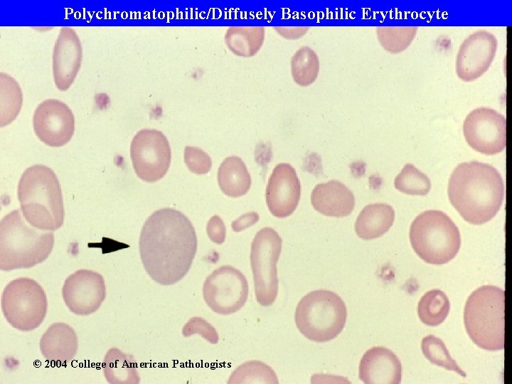 Polychromatophilic/Diffusely Basophilic Erythrocyte © 2004 College of American Pathologists 