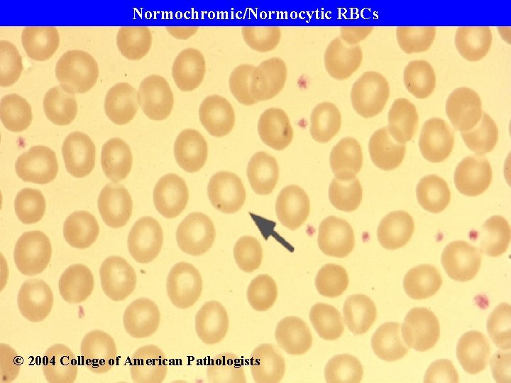 Normochromic/Normocytic RBCs © 2004 College of American Pathologists 