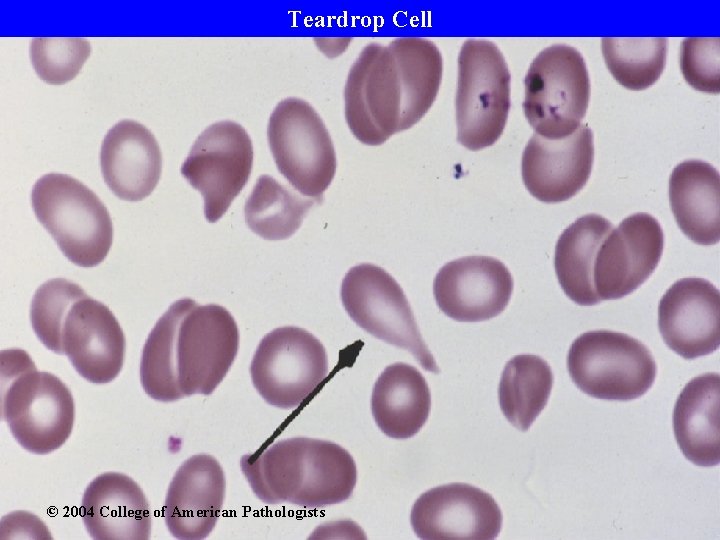 Teardrop Cell © 2004 College of American Pathologists 