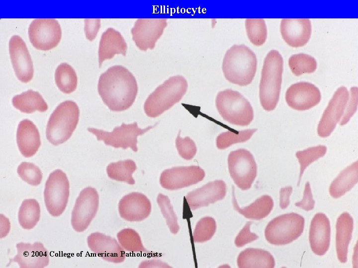 Elliptocyte © 2004 College of American Pathologists 