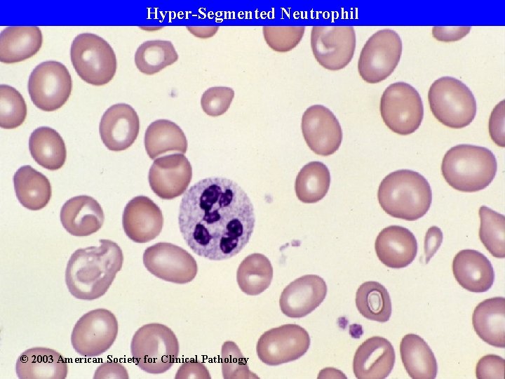 Hyper-Segmented Neutrophil © 2003 American Society for Clinical Pathology 