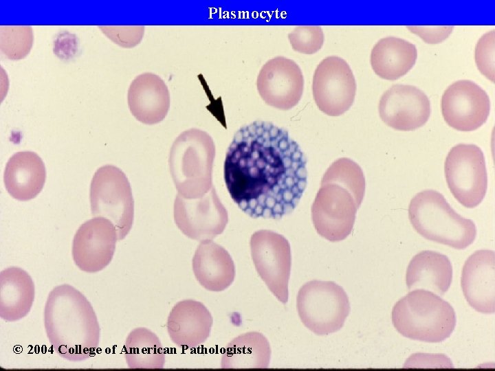Plasmocyte © 2004 College of American Pathologists 