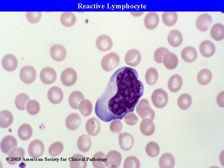 Reactive Lymphocyte © 2003 American Society for Clinical Pathology 