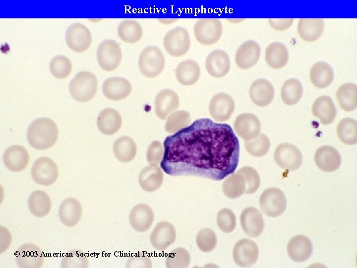 Reactive Lymphocyte © 2003 American Society for Clinical Pathology 