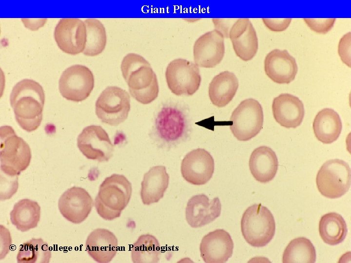 Giant Platelet © 2004 College of American Pathologists 