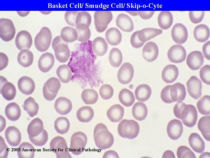 Basket Cell/ Smudge Cell/ Skip-o-Cyte © 2003 American Society for Clinical Pathology 