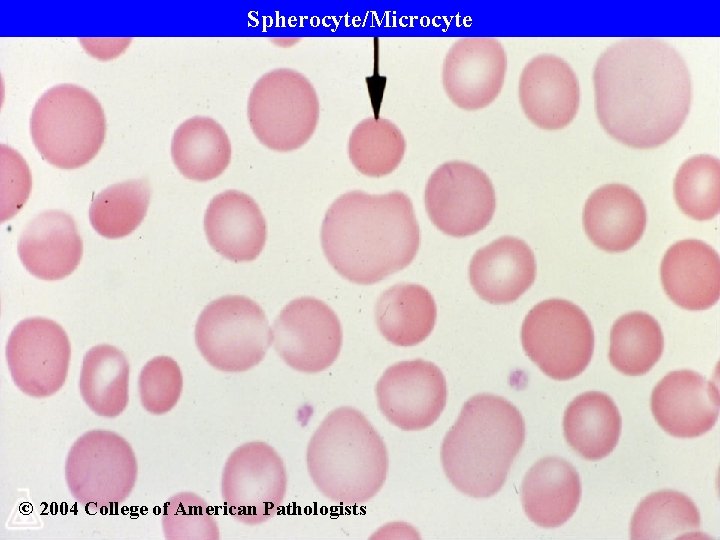 Spherocyte/Microcyte © 2004 College of American Pathologists 