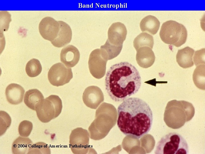 Band Neutrophil © 2004 College of American Pathologists 