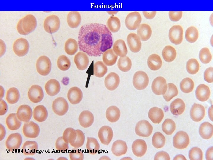 Eosinophil © 2004 College of American Pathologists 